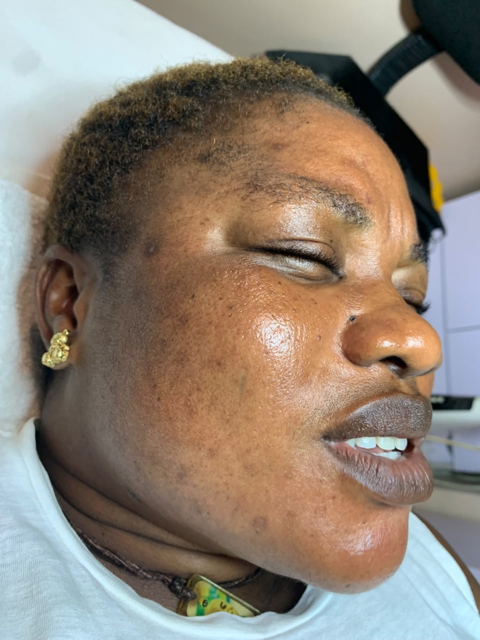 Radiance Steam Facial & Peel